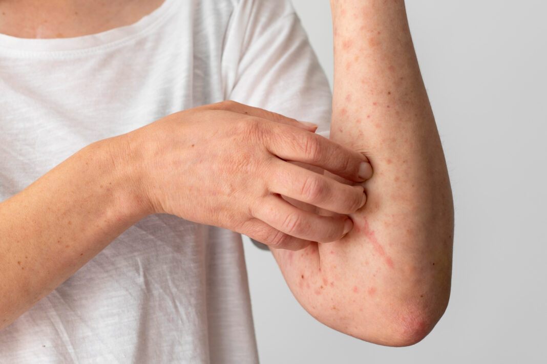 skin-allergy-reaction-person-s-arm0