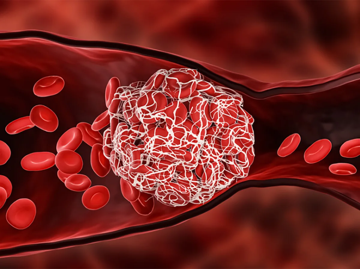 Специалист объяснила, как уменьшить уровень опасного холестерина, приводящего к образованию тромбов0